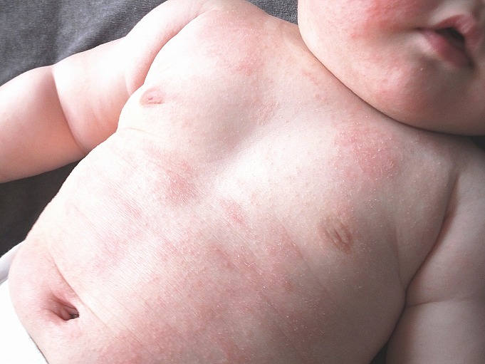 児湿疹