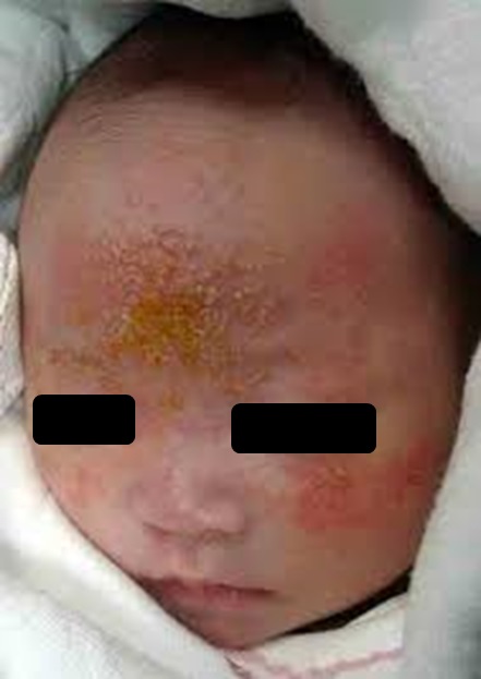 出生3ヶ月まで額・鼻に皮脂量が多い。３ヶ月を過ぎると急激に減少。