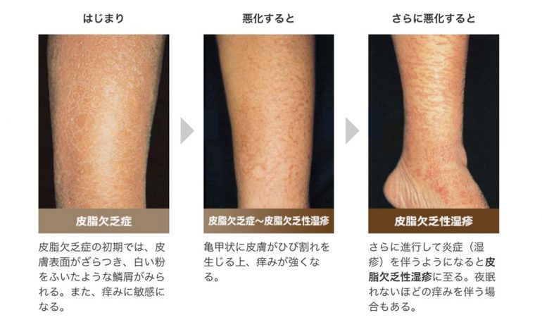 赤ちゃん・子供のスキンケアと保湿剤の塗り方｜尼崎の「にこにこクリニック」